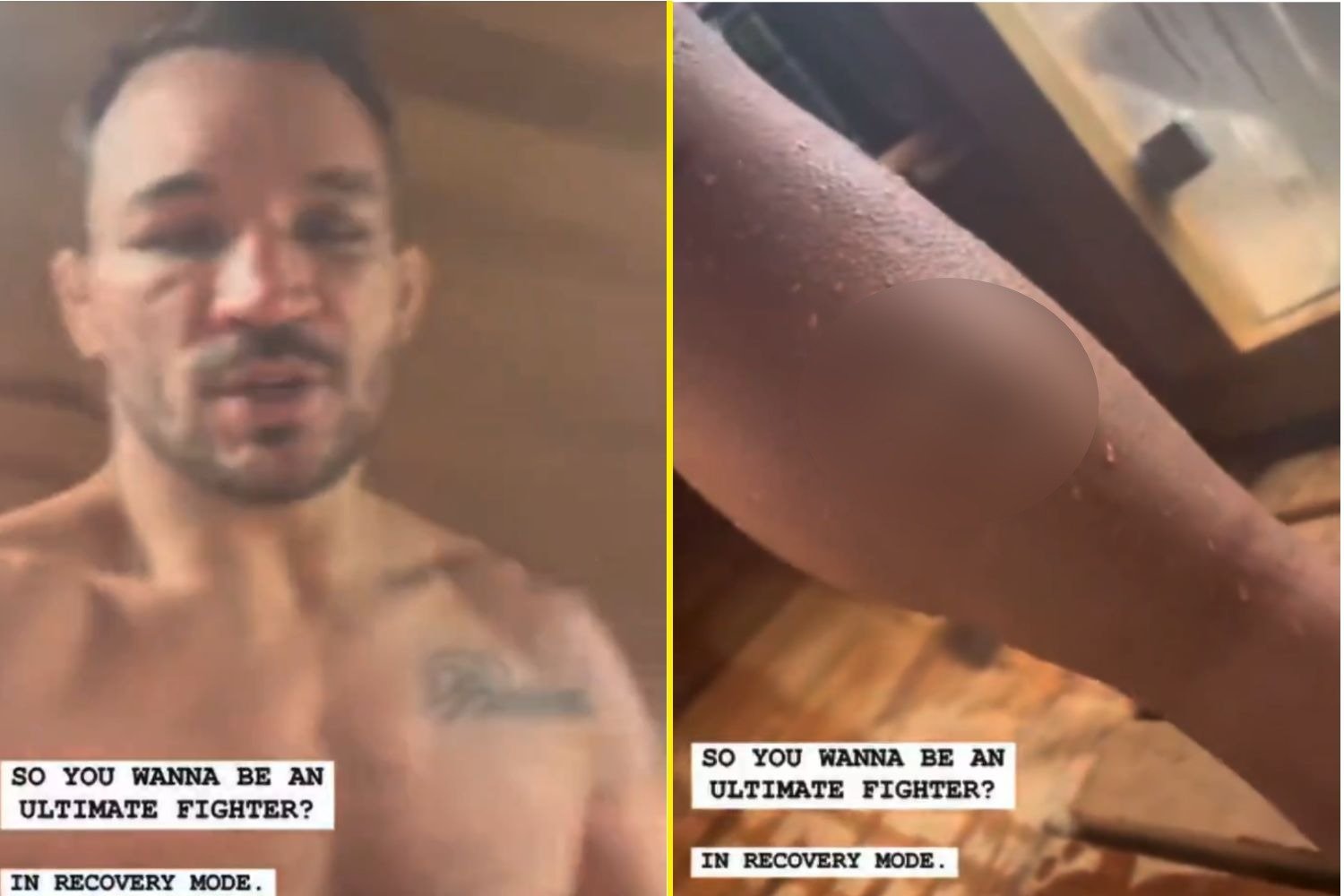 'Most pain I’ve ever been in' -Michael Chandler explains brutal injuries in gruesome video weeks after Charles Oliveira fight