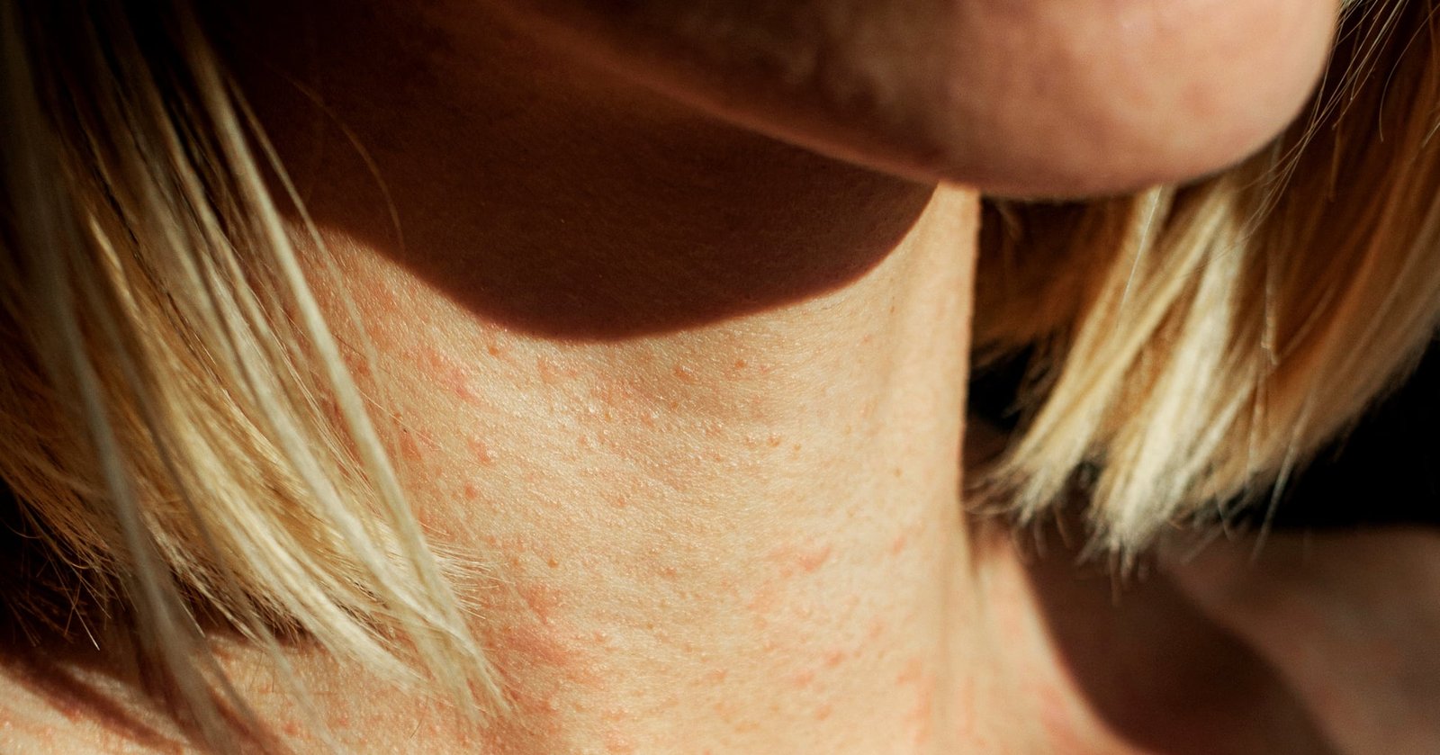 5 Eczema Hacks to Try, According to Doctors