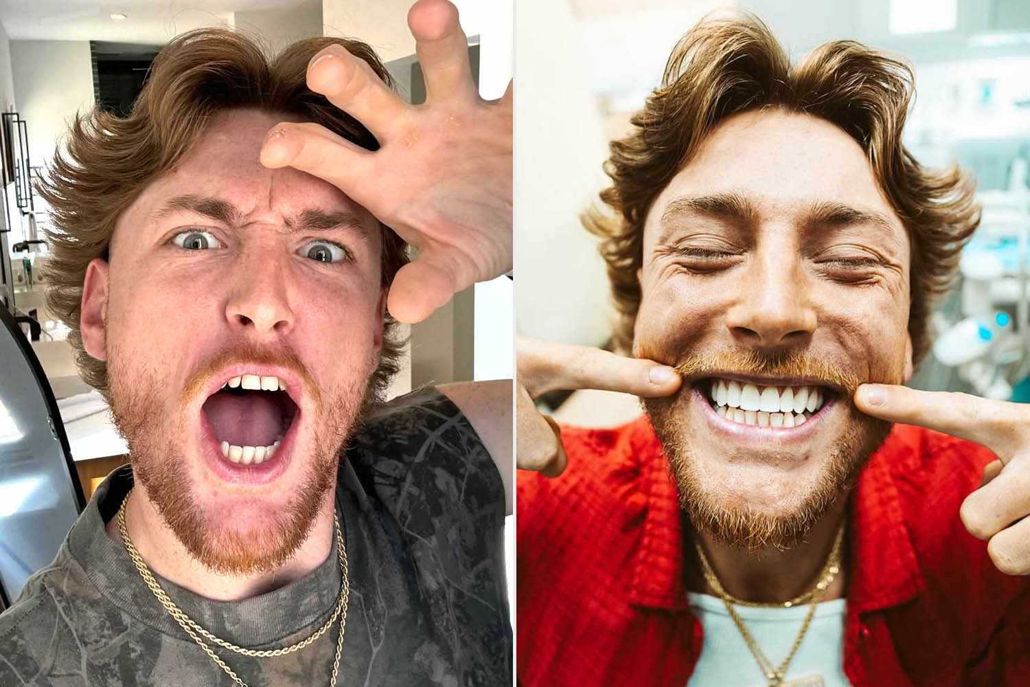 Bailey Zimmerman Shows Off His New Teeth After Getting Veneers